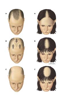 oblici opadanja kose muško i žensko